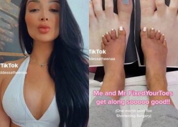 Reactions as woman has a toe-shortening surgery