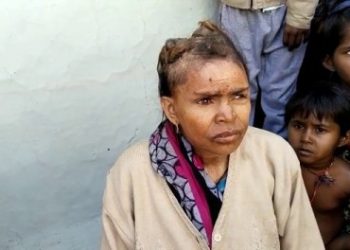 Woman left in pain as ‘horns’ start growing out of her head (photos)