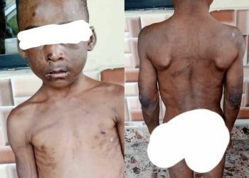 Horrific photos of a child brutalized, chained for weeks by his guardian in Abia