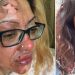 Mum left with skin peeling off her face after egg exploded during TikTok challenge