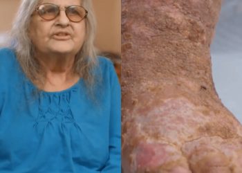 Woman with ‘maggots in between her toes’ says she’s devastated after being sent home from hospital without cure