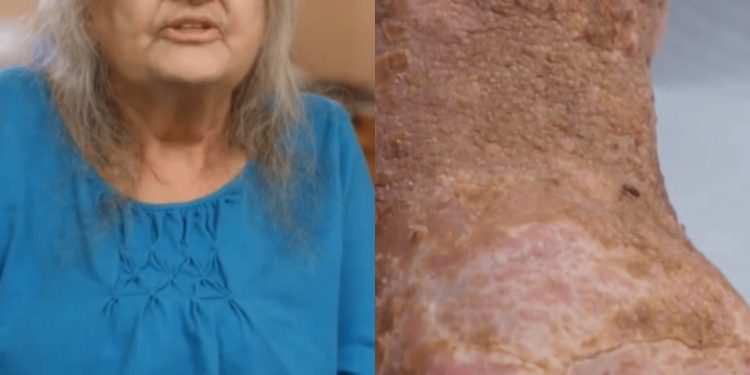 Woman with ‘maggots in between her toes’ says she’s devastated after being sent home from hospital without cure