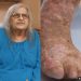 Woman with ‘maggots in between her toes’ says she’s devastated after being sent home from hospital without cure