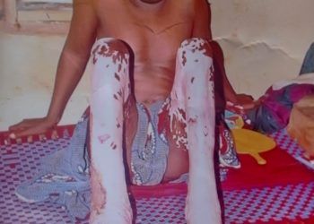 Gas Explosion injures 27 year old Ebonyi man,  seeks financial assistance