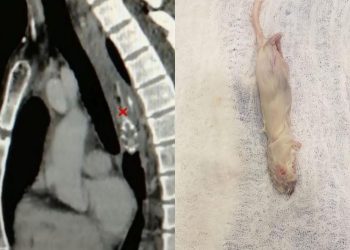 Whole mouse dug out of patient’s esophagus during surgery
