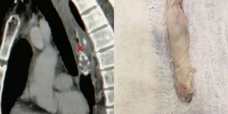 Whole mouse dug out of patient’s esophagus during surgery