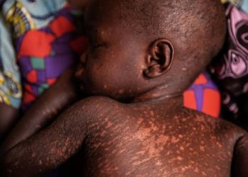 19 children die from measles complications in Adamawa state