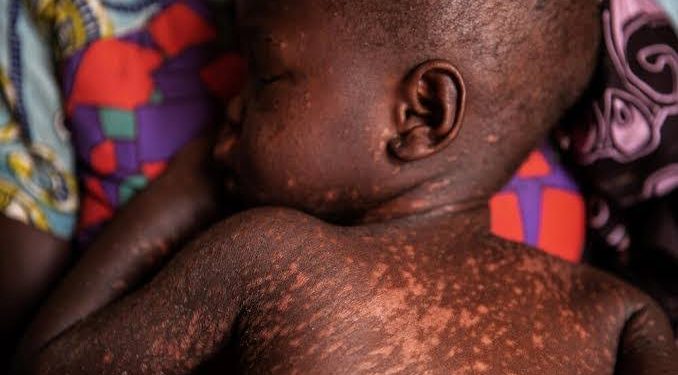 19 children die from measles complications in Adamawa state
