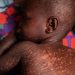 19 children die from measles complications in Adamawa state