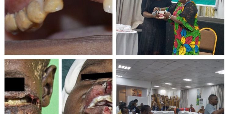 NGO Trains Ebonyi Health Workers On Eradication Of Noma Disease, Flag off Free Medical treatment for Noma Patients