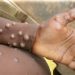 Africa CDC declares monkey pox public health emergency