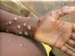 Africa CDC declares monkey pox public health emergency