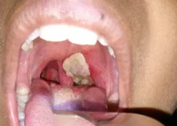10 dead, 40 hospitalised as diphtheria hits Kano