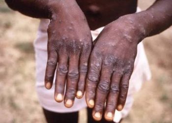 NCDC Confirms 55 Mpox Cases In 21 States, FCT