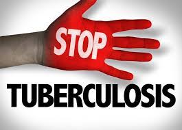 Tuberculosis k!lls 35 in Nasarawa