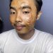 Man contracts horror skin disease from wearing second-hand clothes