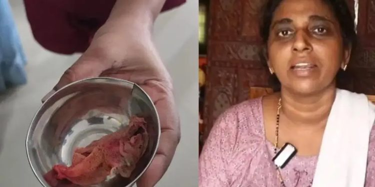 Surgeon’s cloth found inside woman’s abdomen three months after surgery