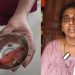 Surgeon’s cloth found inside woman’s abdomen three months after surgery