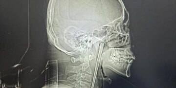Drunkard spent 8 years with metal chopstick stuck in his throat