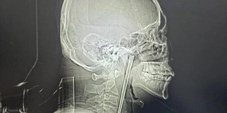 Drunkard spent 8 years with metal chopstick stuck in his throat